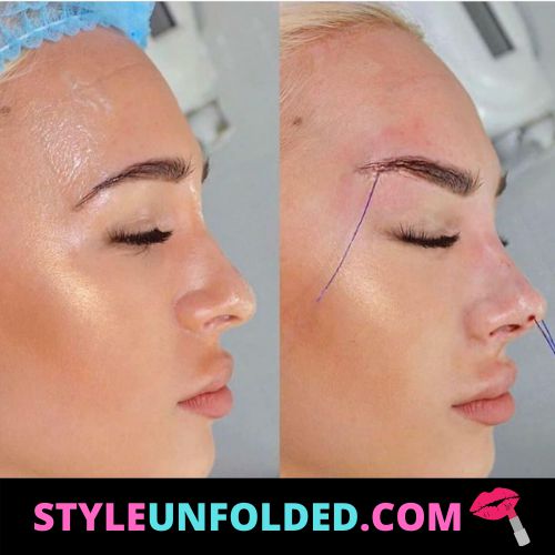 eyebrow thread lift treatment - how to get rid of hooded eyes without surgery